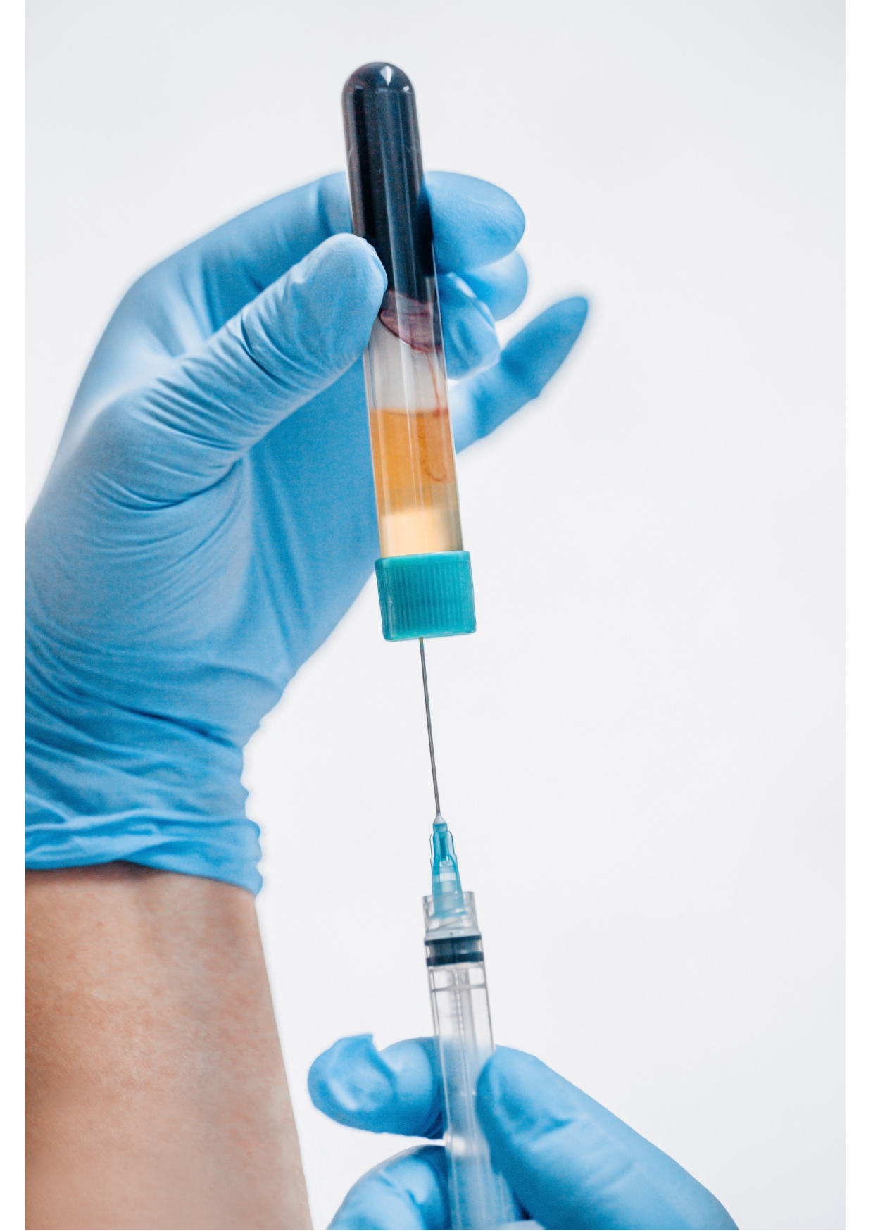 Terapia osoczem bogatopłytkowym (PRP)